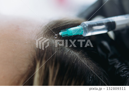 close up on woman head getting mesotherapy injections for stronger and healthier hair 132809311