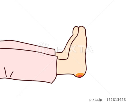 踵部の褥瘡 踵部の褥瘡 132813428