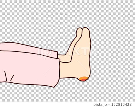 踵部の褥瘡 踵部の褥瘡 132813428