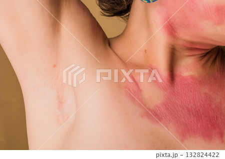Woman showing red skin condition on chest and neck Woman showing red skin condition on chest and neck 132824422