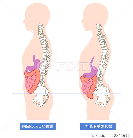 内臓下垂　内臓の位置が下がっている状態 132844691