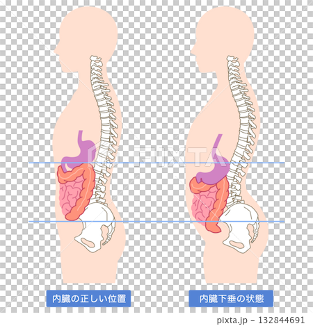 内臓下垂　内臓の位置が下がっている状態 132844691