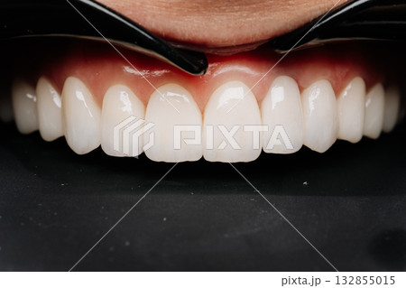 Porcelain veneers smile biting black tool, dental aesthetic macro closeup on black 132855015