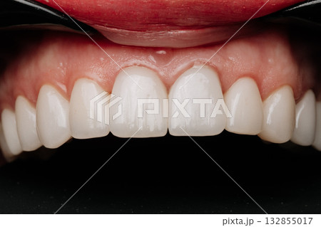 Macro closeup of upper porcelain veneers with healthy pink gums on black background Macro closeup of upper porcelain veneers with healthy pink gums on black background 132855017