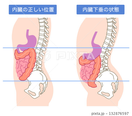 内臓下垂　内臓の位置が下がっている状態 132876597