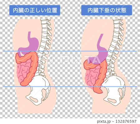 内臓下垂　内臓の位置が下がっている状態 132876597