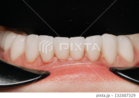 Macro closeup of lower porcelain veneers with healthy gums on black background 132887329