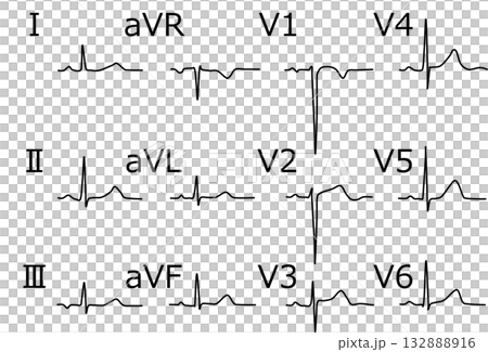 Electrocardiogram graphic material illustration Electrocardiogram graphic material illustration 132888916