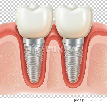 Dental Implants Cross Section Dental Implants Cross Section 132901352