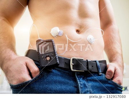 Diabetic man with an insulin pump connected in his abdomen and keeping the insulin pump 132917080