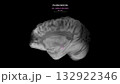 Parkinson Dopamine Loss Direct Pathway Disruption Sagittal View 132922346