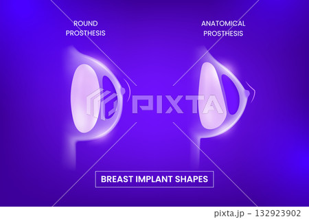 3D poster comparing round and anatomical silicone breast implants, neon purple background. 3D poster comparing round and anatomical silicone breast implants, neon purple background. 132923902