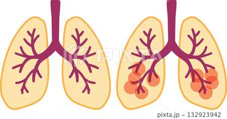 肺 肺 132923942