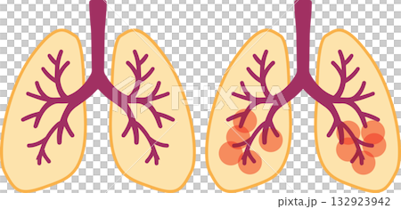 肺 肺 132923942