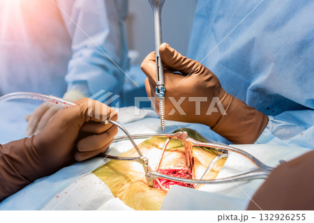 Spinal surgery. Surgeon tightens the polyaxial screw into the patient's spine.  132926255