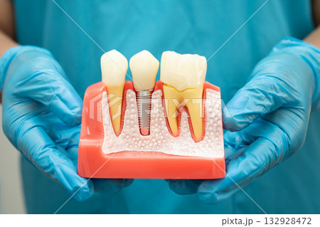 Asian dentist holding dental implant, artificial tooth roots into jaw, root canal of dental treatment, gum disease, teeth model for dentist. 132928472
