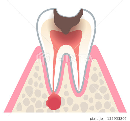 むし歯が進行し、歯の根にある神経に膿がたまった歯の断面図　根管治療　 132933205