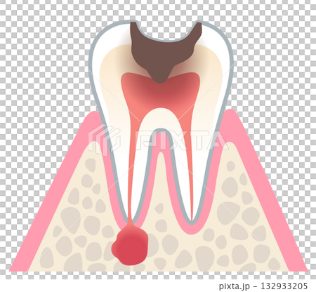 むし歯が進行し、歯の根にある神経に膿がたまった歯の断面図　根管治療　 132933205