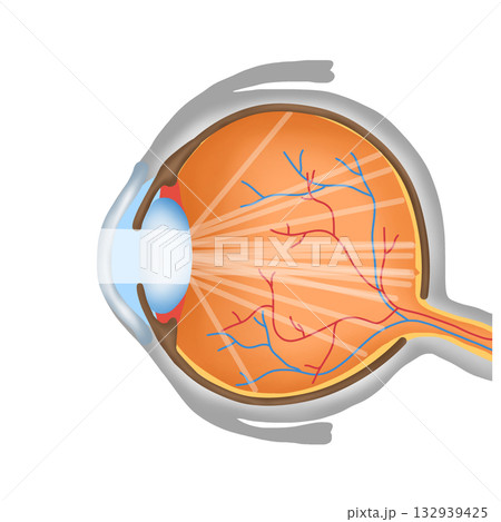 Cataract Eye Condition Diagram, Opaque Lens and Light Scattering in Eyeball 132939425