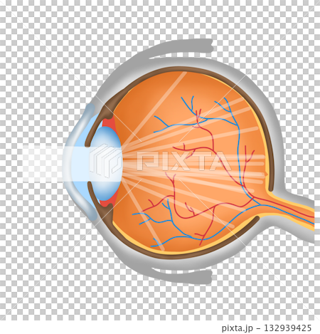 Cataract Eye Condition Diagram, Opaque Lens and Light Scattering in Eyeball 132939425