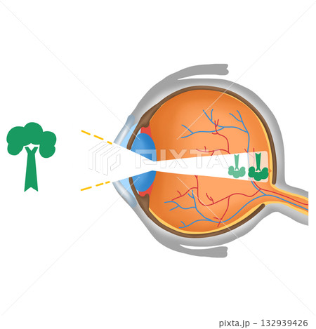 Astigmatism Eye Vision Diagram, Object Blurry Focus on Retina, hand drawn water color of Eye Anatomy  132939426