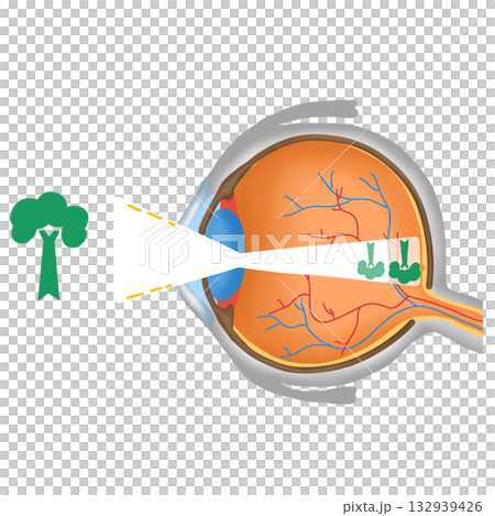 Astigmatism Eye Vision Diagram, Object Blurry Focus on Retina, hand drawn water color of Eye Anatomy Astigmatism Eye Vision Diagram, Object Blurry Focus on Retina, hand drawn water color of Eye Anatomy 132939426