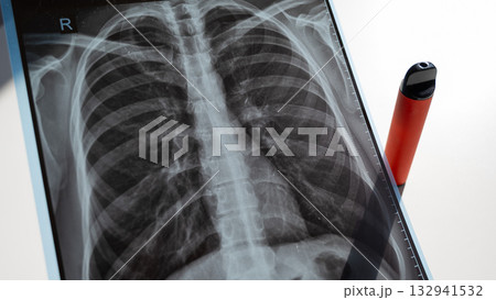 Disposable Vape and Lung X-Ray.  132941532