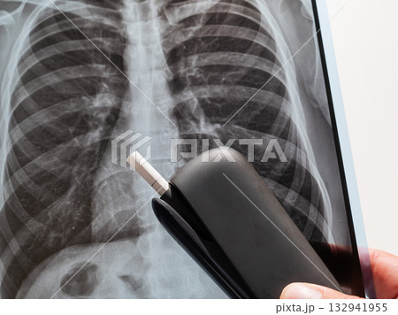 Electronic cigarette and lung x-ray. Tobacco heating system. Electronic cigarette and lung x-ray. Tobacco heating system. 132941955