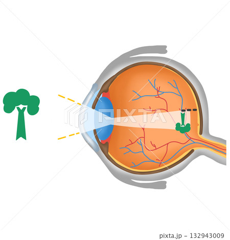 Myopia or Nearsightedness, Eye Vision Diagram, Focus Before Retina Myopia or Nearsightedness, Eye Vision Diagram, Focus Before Retina 132943009