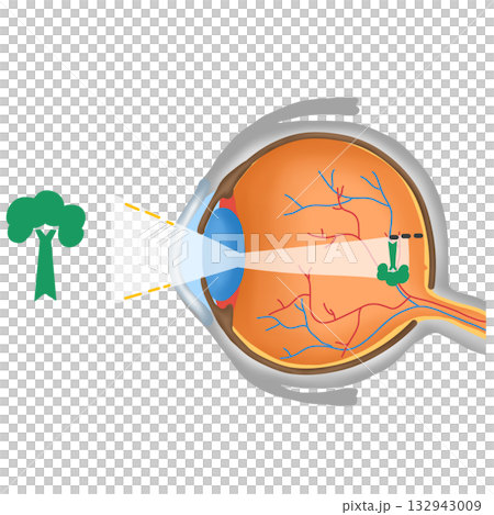 Myopia or Nearsightedness, Eye Vision Diagram, Focus Before Retina Myopia or Nearsightedness, Eye Vision Diagram, Focus Before Retina 132943009