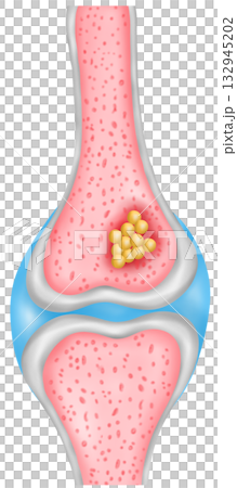 Bone Cancer Cross Section illustration 132945202