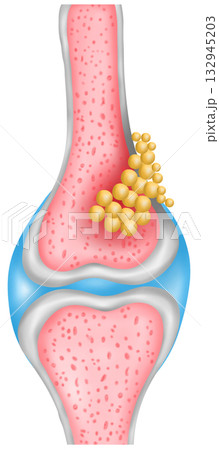 Bone Cancer Cross Section illustration 132945203