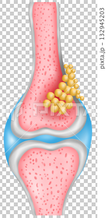 Bone Cancer Cross Section illustration 132945203