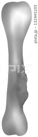 Bone Cancer or Osteosarcoma illustration 132945205