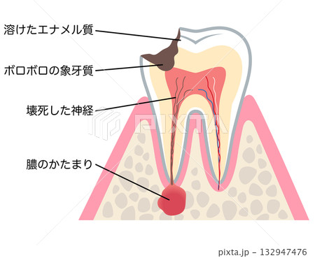 むし歯が進行し、歯の根にある神経に膿がたまった歯の断面図　根管治療 132947476