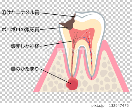 むし歯が進行し、歯の根にある神経に膿がたまった歯の断面図　根管治療 132947476