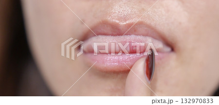 Mouth Ulcer Sore or Aphthous Stomatitis. Oral Health and Medical concepts 132970833