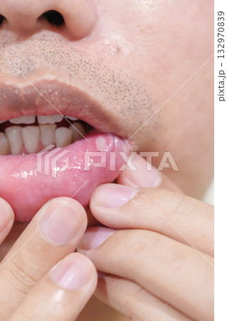 Mouth Ulcer Sore or Aphthous Stomatitis. Oral Health and Medical concepts Mouth Ulcer Sore or Aphthous Stomatitis. Oral Health and Medical concepts 132970839