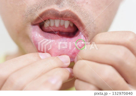 Mouth Ulcer Sore or Aphthous Stomatitis. Oral Health and Medical concepts 132970840