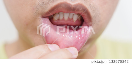 Mouth Ulcer Sore or Aphthous Stomatitis. Oral Health and Medical concepts 132970842