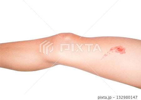 burn with blisters on boy leg, isolated on white with clipping path burn with blisters on boy leg, isolated on white with clipping path 132980147