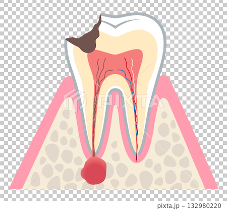 牙齒橫切面顯示嚴重齲壞，牙根神經內積聚膿液－根管治療 132980220