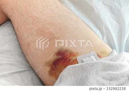 Hematoma on a men's leg close-up. Huge bruise on the leg of a man after endovascular repair due to taking blood thinning medication drugs. Doctor's hand in blue gloves examining patient. Hemorrhage Hematoma on a men's leg close-up. Huge bruise on the leg of a man after endovascular repair due to taking blood thinning medication drugs. Doctor's hand in blue gloves examining patient. Hemorrhage 132982238