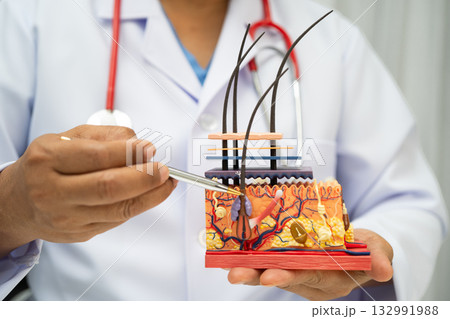 Hair transplant, Asian dermatologist doctor holding skin structure anatomy model for treatment in hospital. Hair transplant, Asian dermatologist doctor holding skin structure anatomy model for treatment in hospital. 132991988