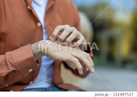 Man suffering from an allergic reaction or skin condition, scratching his irritated forearm with his fingers, experiencing discomfort from constant itching Man suffering from an allergic reaction or skin condition, scratching his irritated forearm with his fingers, experiencing discomfort from constant itching 132997527