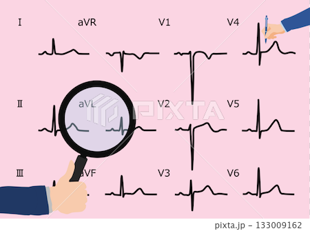 Graphic illustration of interpreting an electrocardiogram Graphic illustration of interpreting an electrocardiogram 133009162
