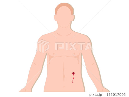 Vector illustration of a man clutching his abdomen in pain. 133017093