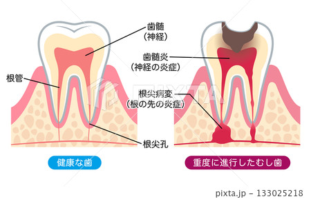 健康な歯と進行したむし歯　歯の内部構造 133025218