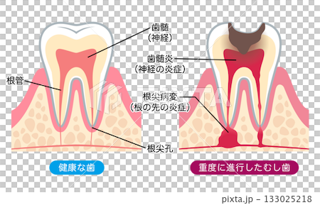 健康な歯と進行したむし歯　歯の内部構造 133025218