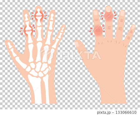 へバーデン結節とブシャール結節 へバーデン結節とブシャール結節 133066610